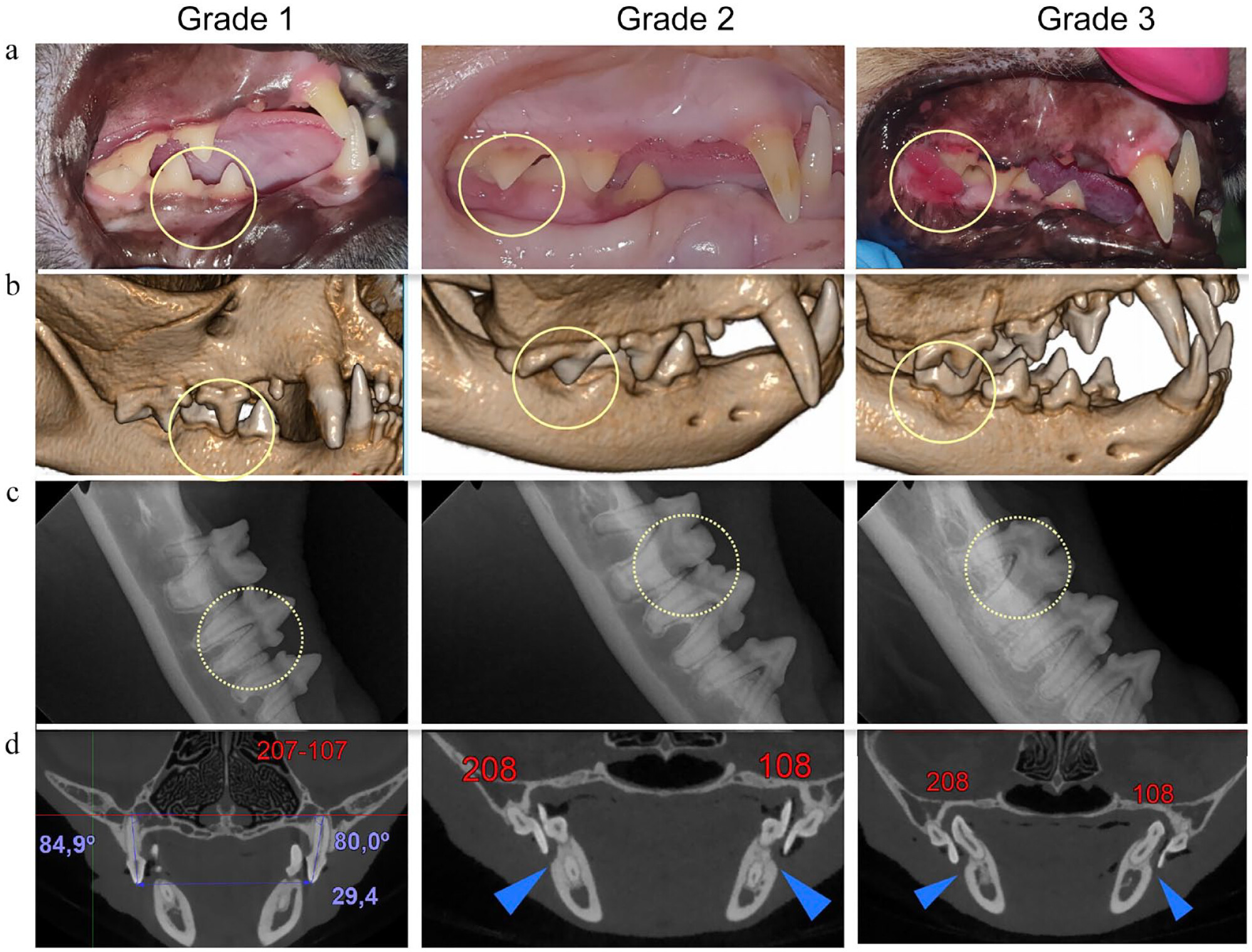 Materiał z projektu badawczego: (a) zdjęcia fotograficzne, (b) kliniczne trójwymiarowe rekonstrukcje skanów CBCT, (c) radiogramy oraz (d) obrazy przekrojów czołowych (koronalnych) w CBCT przedstawiające trzy stopnie nasilenia zmian w tkankach miękkich żuchwy wtórnych do wady zgryzu.